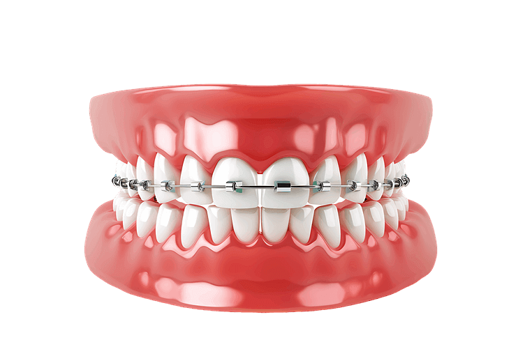 Braces on Upper Teeth